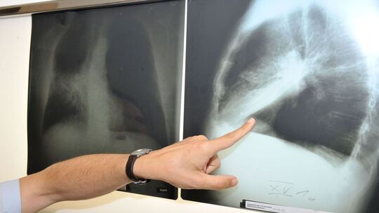 Neuer WHO-Bericht zu nicht-übertragbaren Krankheiten