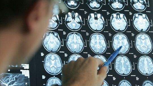 Arzt beurteilt Gehirnquerschnitte einer Schlaganfall-Patientin