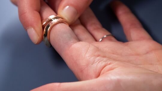 Verfärbungen durch Modeschmuck sind am Finger zu sehen Verfärbungen durch Modeschmuck sind am Finger zu sehen