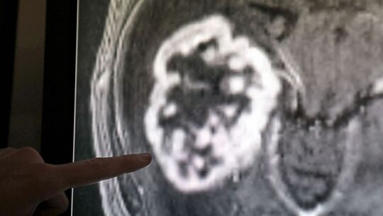 Die Diagnose Krebs ist oft ein schwerer Schlag