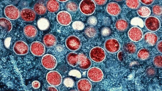 Mpox weitet sich in Berlin auf neue Personengruppen aus Mpox weitet sich in Berlin auf neue Personengruppen aus